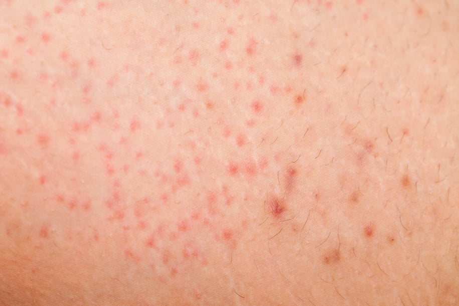 Folliculitis on female skin