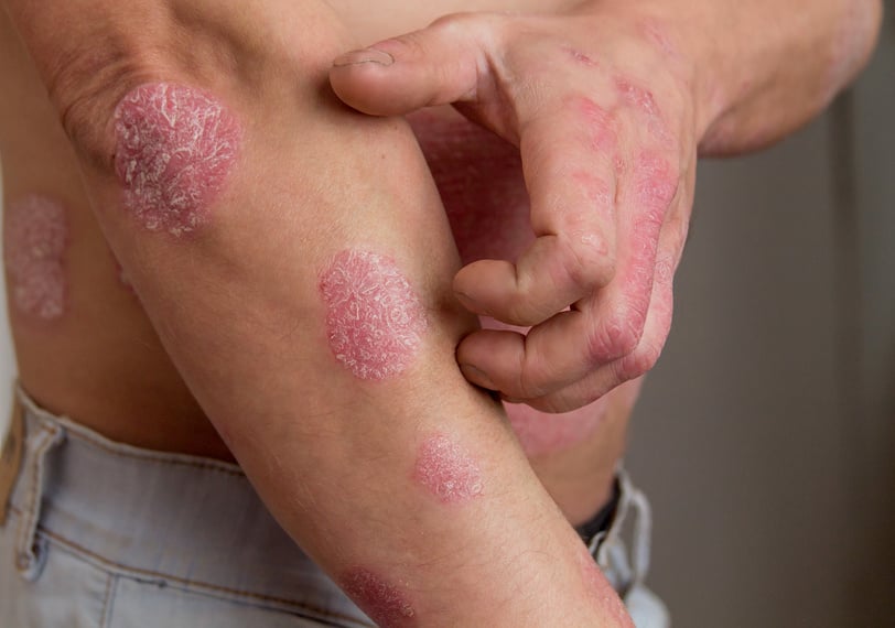 the man on the arm and abdomen psoriasis