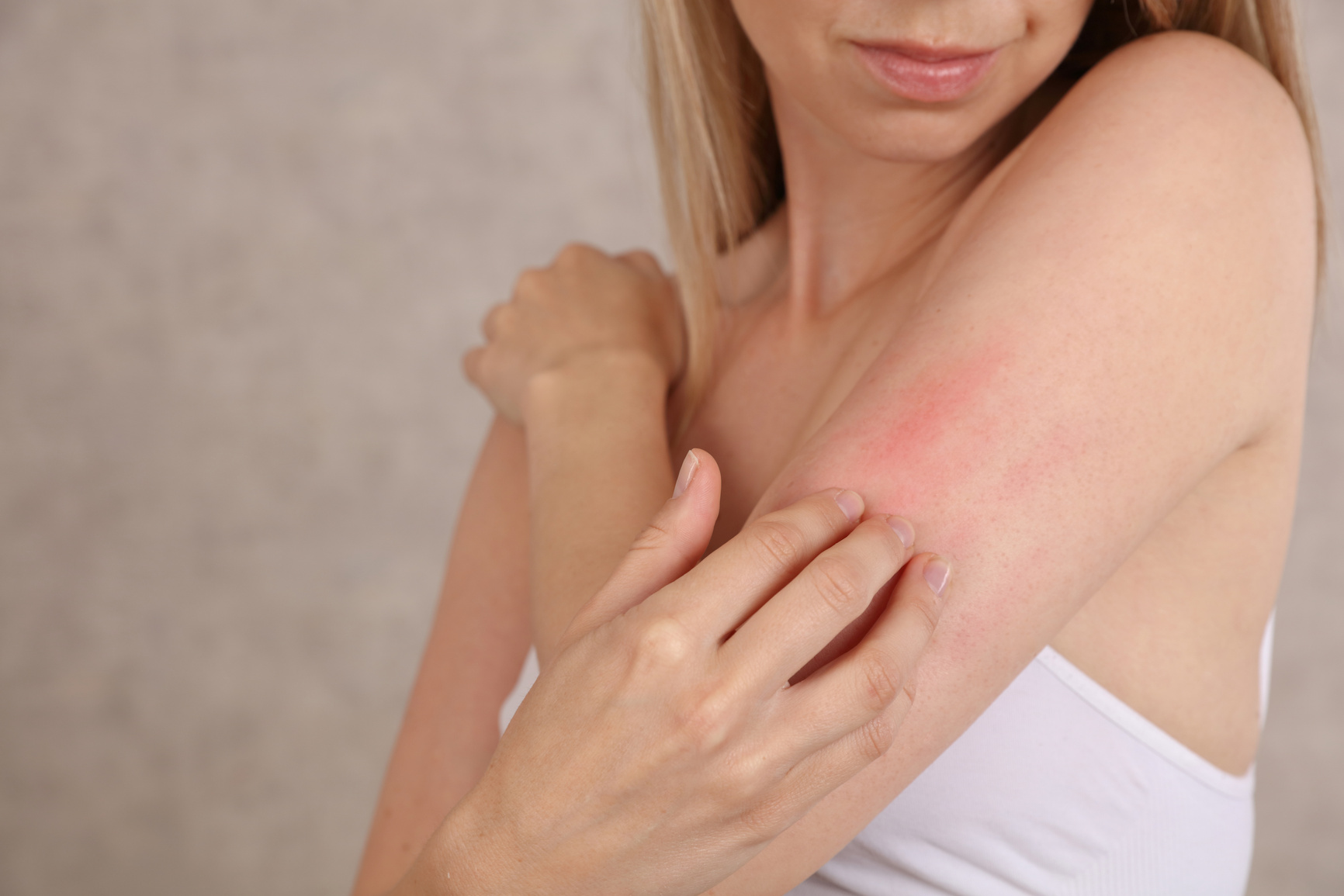 Woman Scratching an itch close up . Sensitive Skin, Food allergy symptoms, Irritation