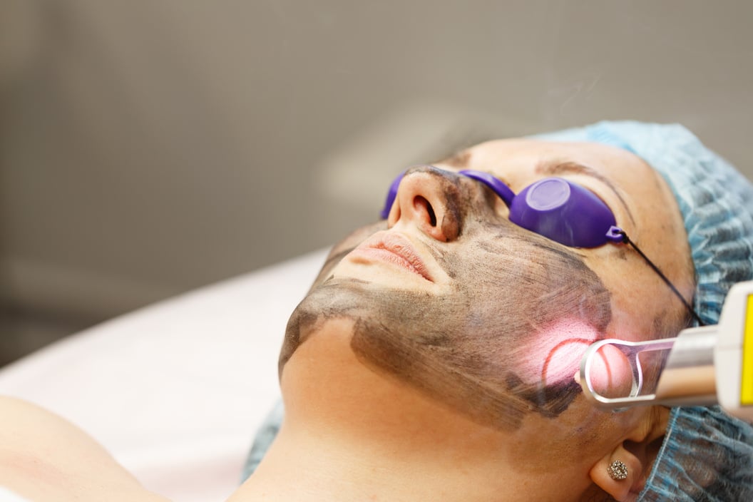 Carbon Peeling. Laser Pulses.